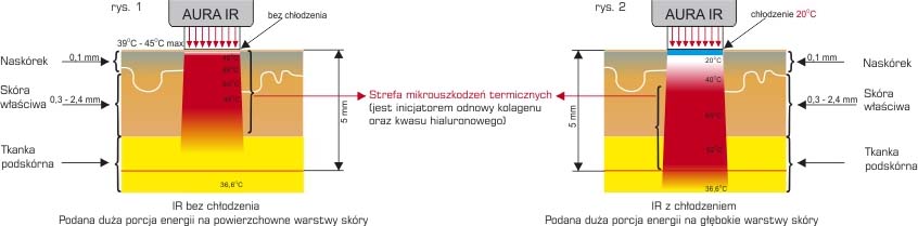 Jak dziaa thermolifting IR - Aura