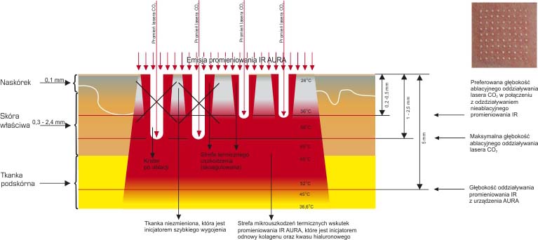 Thermolifting IR Aura + Laser CO2